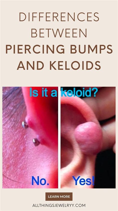 Piercing bump vs keloid what is the difference pictures – Artofit
