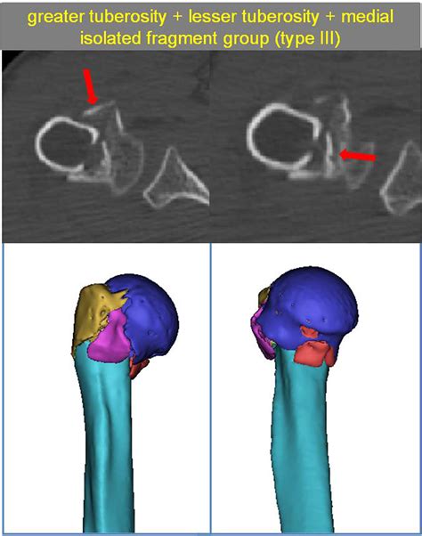 Lesser Tuberosity Humerus