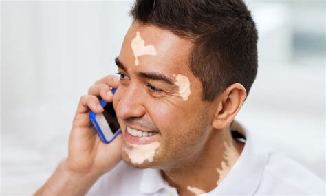 How To Treat Male Skin Pigmentation & Skin Darkening - Causes, Types ...