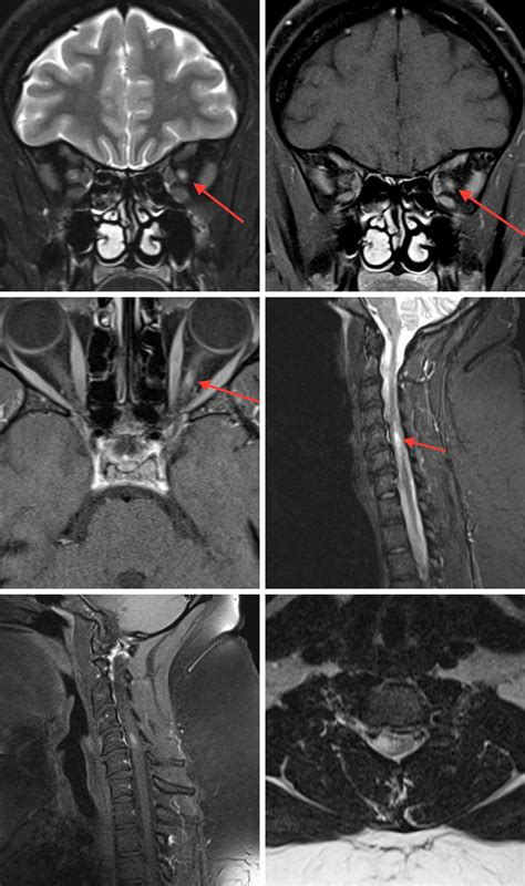 Multiple Sclerosis (MS) | The Neurosurgical Atlas