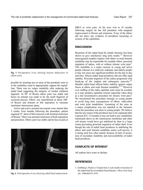 Prosthetic Radial Head 的图像结果