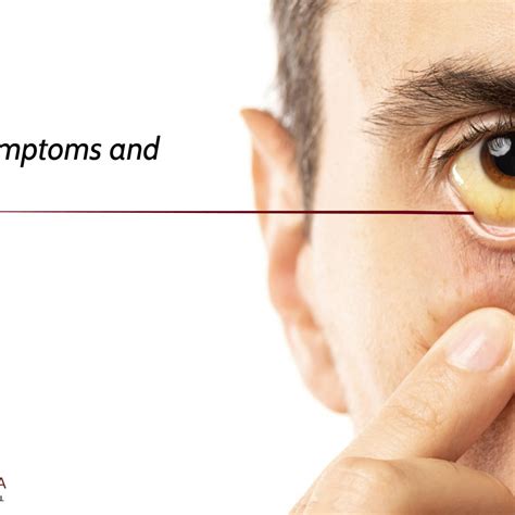 Why Do My Eyes Look Yellow In Pictures - Infoupdate.org