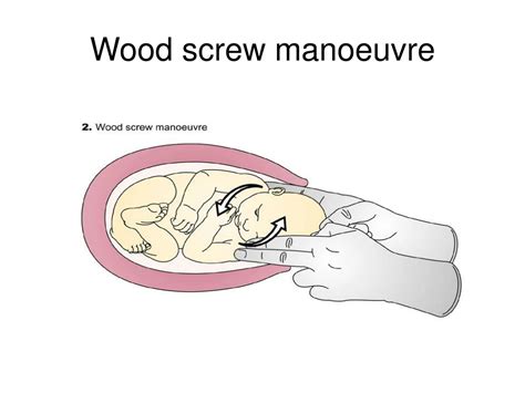 PPT - Shoulder Dystocia PowerPoint Presentation, free download - ID:9116642