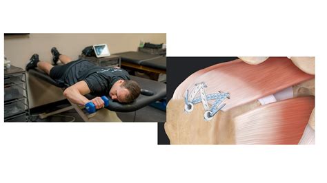 Rehabilitation Following Rotator Cuff Repair - American Sports Medicine Institute