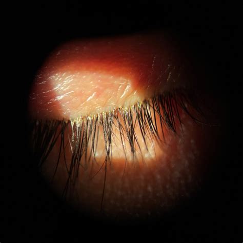 Parasitic Blepharitis Blepharitis / Eyelid Inflammation | Dr Schalk Du