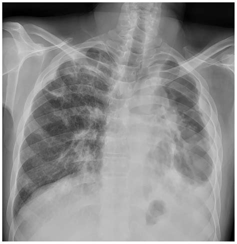 Management of Polydrug-Resistant Tuberculosis