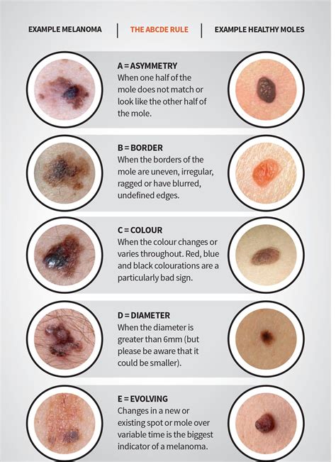 Skin Cancer Moles On Back
