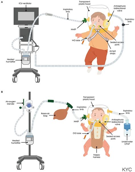 Ventilación Pediátrica En Cuidados Intensivos | La Casa Del Ventilador