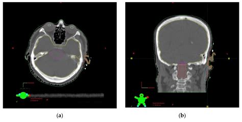 Brachytherapy in the Treatment of Non-Melanoma Skin Peri-Auricular ...