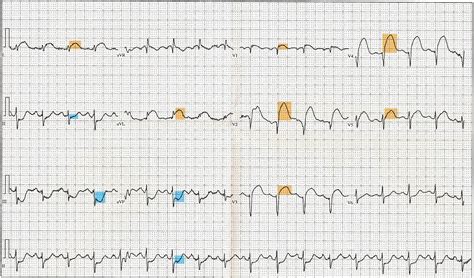 File:12 Lead EKG ST Elevation tracing color coded.jpg - Wikimedia Commons - lateral leads of ecg