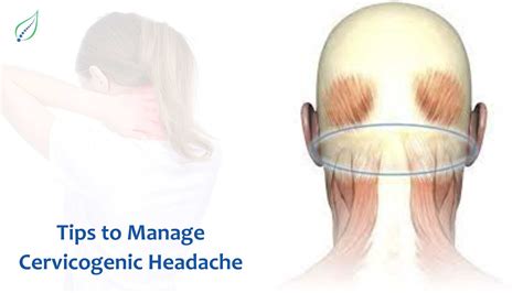 Cervicogenic Headache Treatment At Home