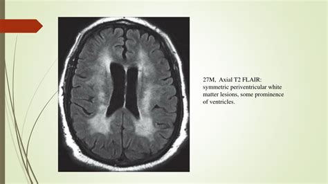 Periventricular White Matter Disease