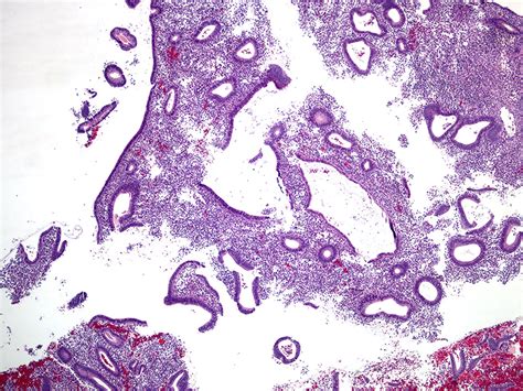 Image result for Disordered Proliferative Endometrium