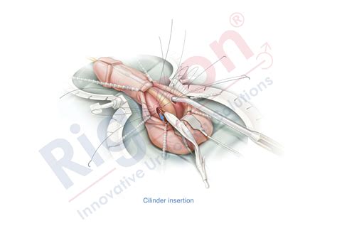Infla10® Pulse™ Series - Inflatable Penile Prosthesis