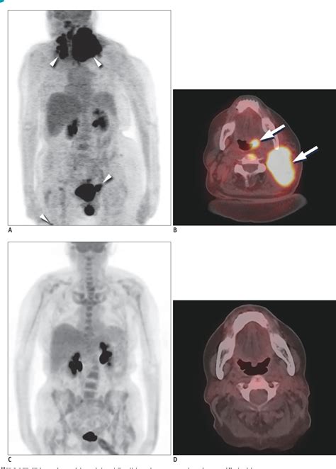 Figure 3 from T-Cell Non-Hodgkin Lymphomas: Spectrum of Disease and the Role of Imaging in the ...