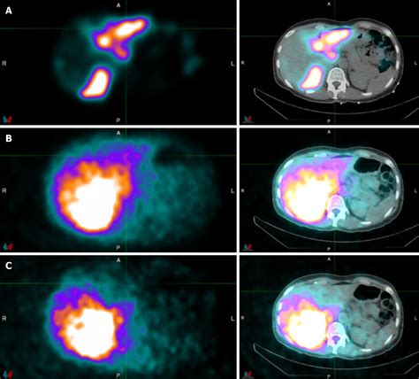 Same day yttrium-90 radioembolization with single photon emission ...