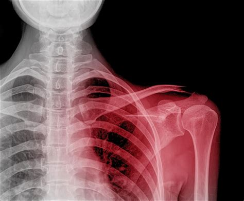 Medical Definition of Dislocation | CHAPTER 6 | Orthopedic Nursing ...