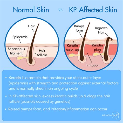 Quick Facts: Keratosis Pilaris | Keratosis Pilaris Produkte – IAHPB