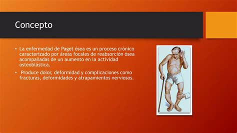 ENFERMEDAD OSEA DE PAGET.pptx