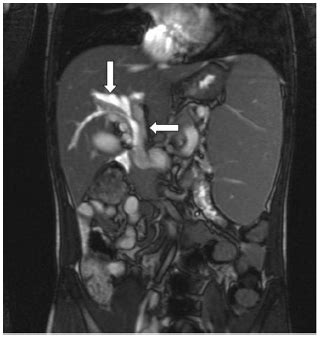 Image result for MRCP Biliary Tree