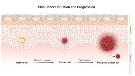 Image result for How Skin Cancer Forms
