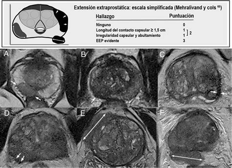 Resonancia magnética de próstata: guía práctica de interpretación e informe según PI-RADS ...