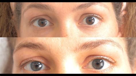 Image result for Eye Color Change Procedure