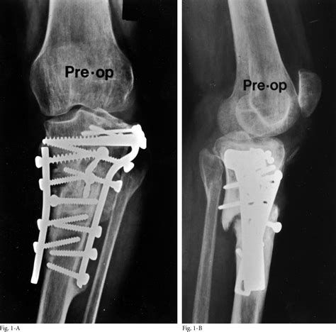 Tibial Plateau Fracture Orif
