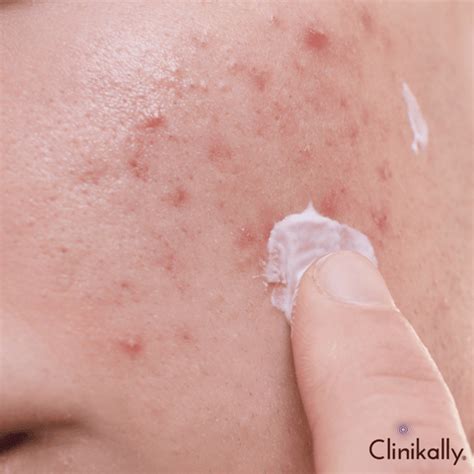 Is Benzoyl Peroxide good for acne? | Clinikally
