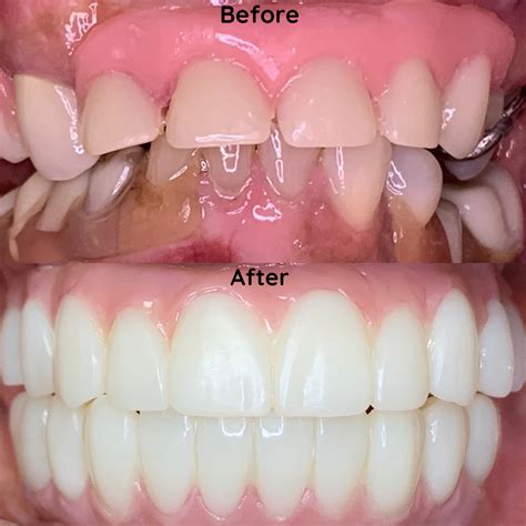 Dentures | Smile Institute - Glades Rd Suite E-6, Boca Raton