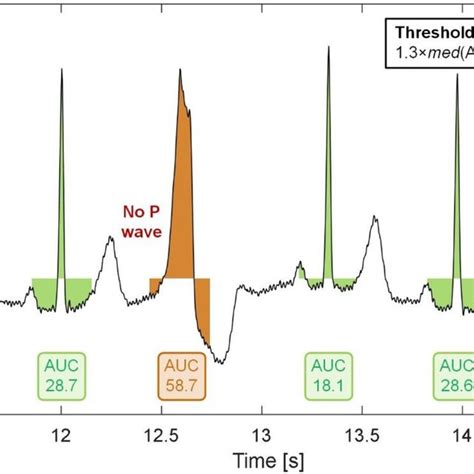 Image result for PVC Localization Chart