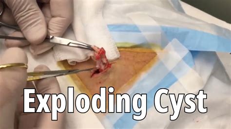 Image result for New Exploding Cysts