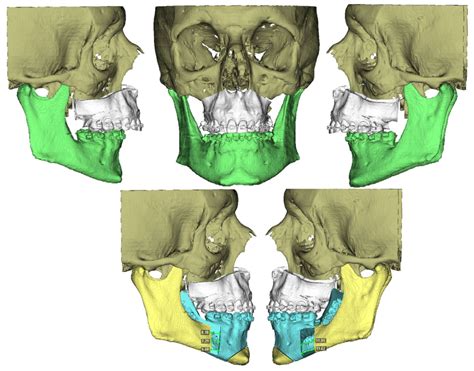 Virtual Guided and Customized Orthognathic Surgery in Patients with ...