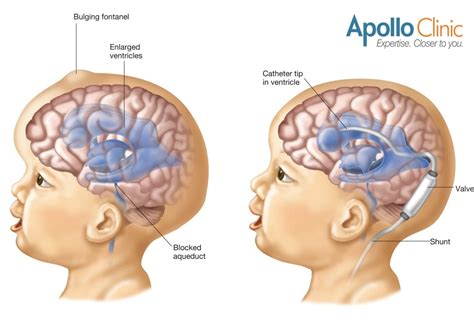 Hydrocephalus In Adults