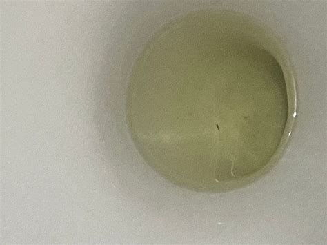 White Specks Urine
