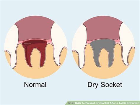 Image result for Tooth Extraction Dry Socket
