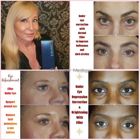 Restylane Eye Treatment Cost at Cristina Lee blog