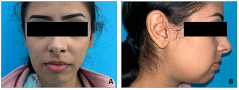 Ameloblastoma of the Mandible in a 16-Year-Old Female—Case Report