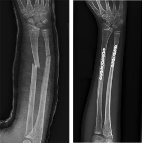 Fractured Ulna And Radius Bones