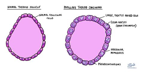 Papillary Thyroid Carcinoma