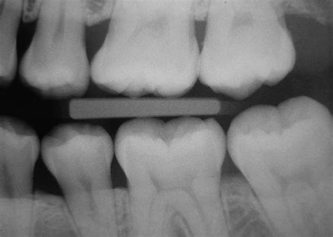 ARE DENTAL X-RAYS NECESSARY? 8 REASONS WHY THEY'RE IMPORTANT - why is called x ray