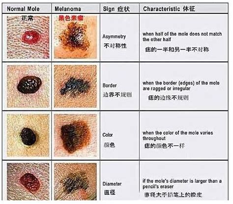 腰右侧长痣,腰缠万贯痣,侧腰上有痣图解_大山谷图库