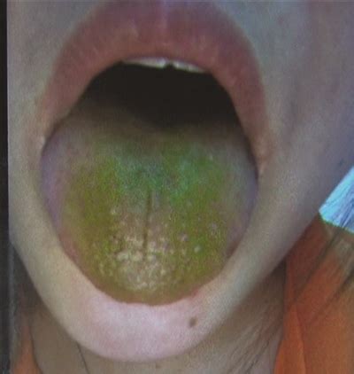 女子吃半根黄瓜后舌苔瞬间变绿 嘴里发麻(图)|黄瓜|舌苔_新浪新闻