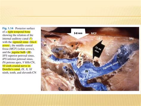 Image result for Temporal Bone Mastoid Process