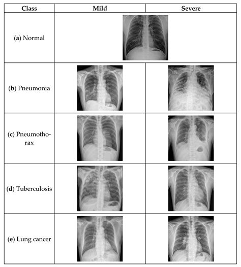 OView-AI Supporter for Classifying Pneumonia, Pneumothorax ...
