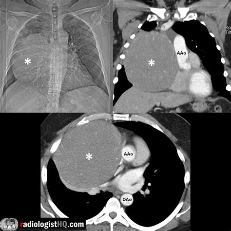 Anterior mediastinal thymoma (*) on x-ray and CT : r/Radiology