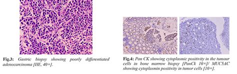 A Unique Presentation of Bone Marrow Involvement in Gastrointestinal ...