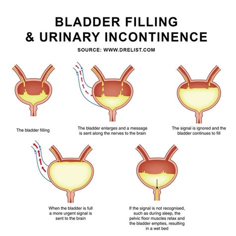 urinary stress incontinence