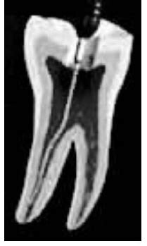 Image result for Pulp Extraction Tooth