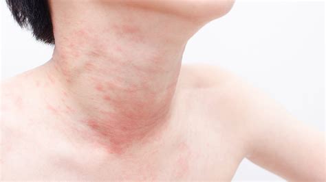 Rash In The Neck